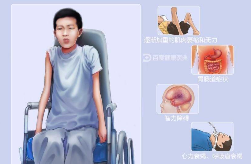 进行性肌营养不良要怎样治疗?
