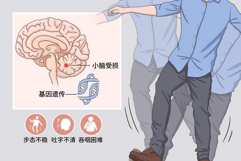 共济失调的类型有哪些?