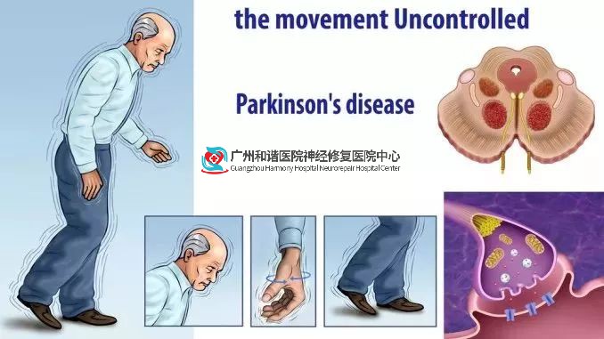 世界帕金森病日 | 手抖不是帕金森病的“专利”,出现这些症状也需警惕!