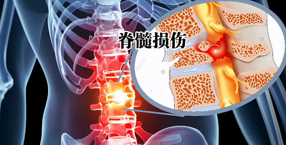 影响脊髓损伤恢复效果的三大因素