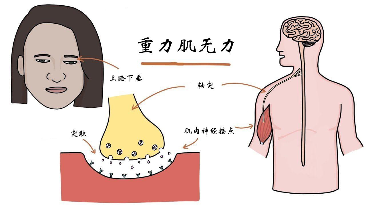 重症肌无力3大危象:这些症状可能危及生命,早了解早防范