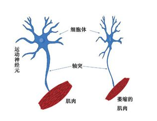 同一屋檐下的不同面孔:运动神经元病VS肌萎缩侧索硬化症