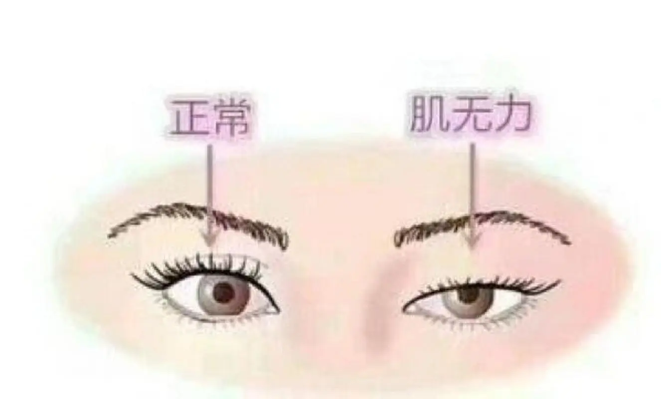 眼肌型重症肌无力的危害有多大?