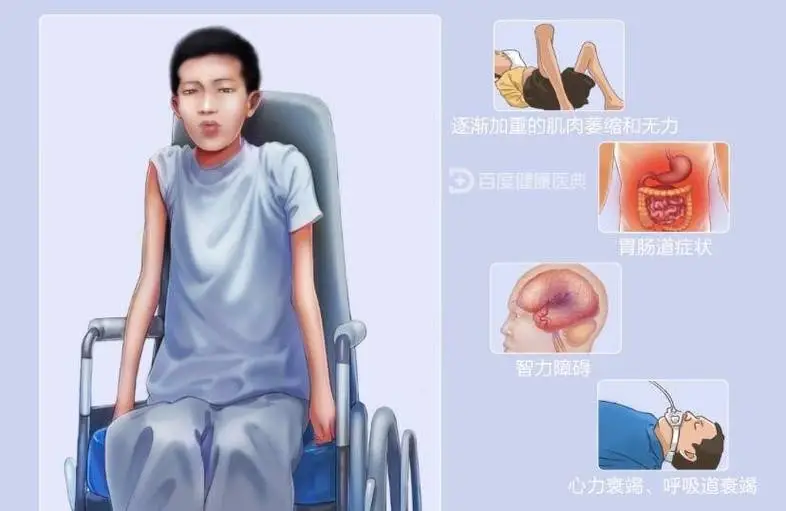 儿童肌营养不良:家长必知的营养与健康知识