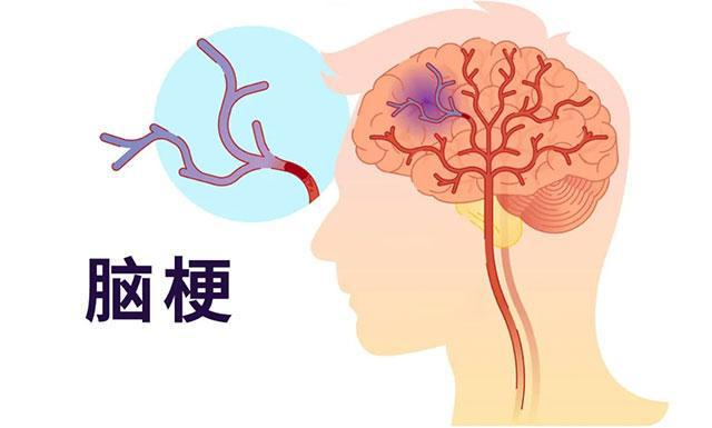 答患者问:轻微脑梗后长期用药是否必要?
