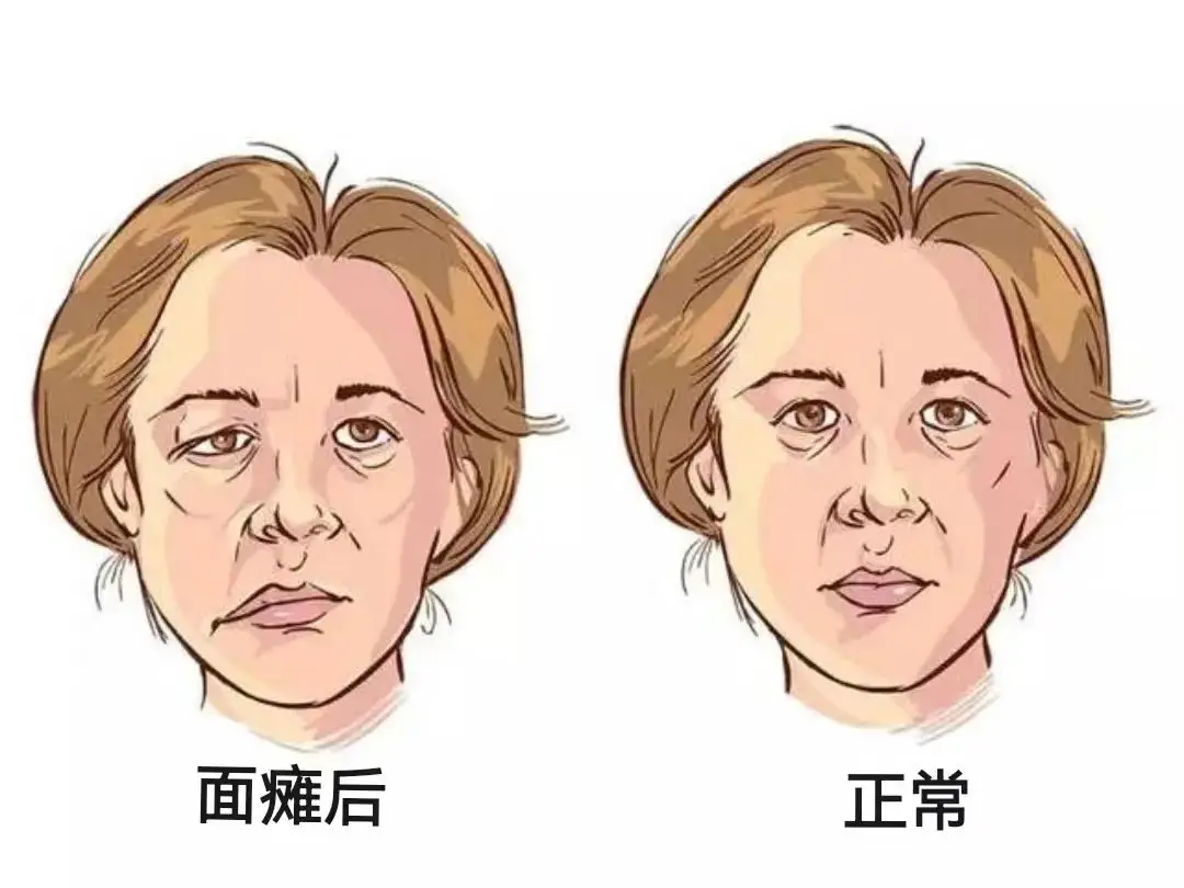 面瘫后，怎么知道神经在恢复？3个表现预示着你的神经开始恢复