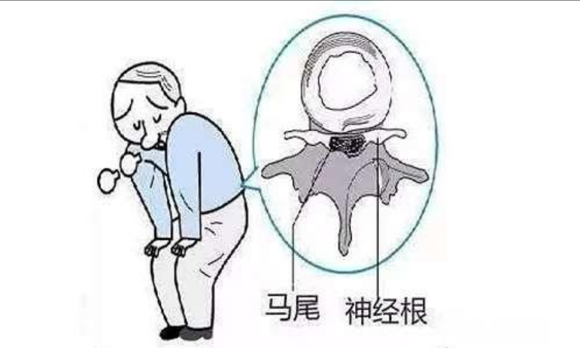 马尾神经损伤引发的神经源性膀胱症状:患者的应对策略