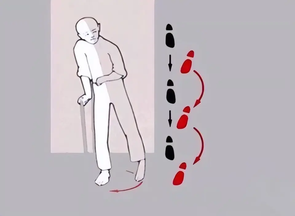 中风偏瘫软瘫期康复:如何实现个性化的精准康复训练?