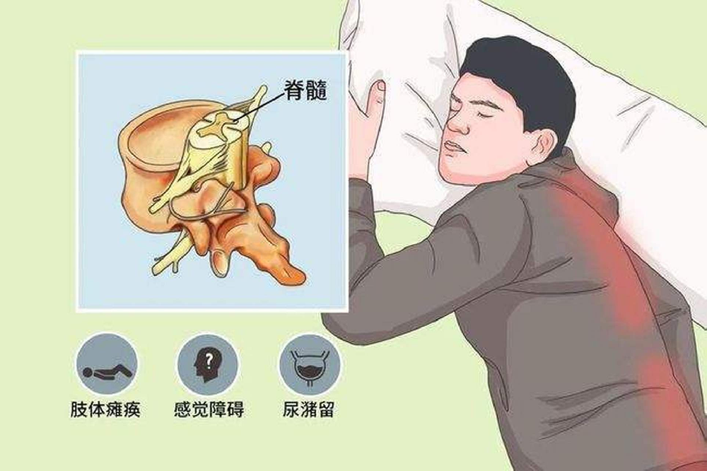 盲目理疗=加速恶化!脊髓炎黄金期必须避免的5大陷阱