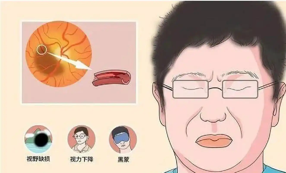 视神经萎缩:科学管理生活习惯,守护你的“视觉生命线”