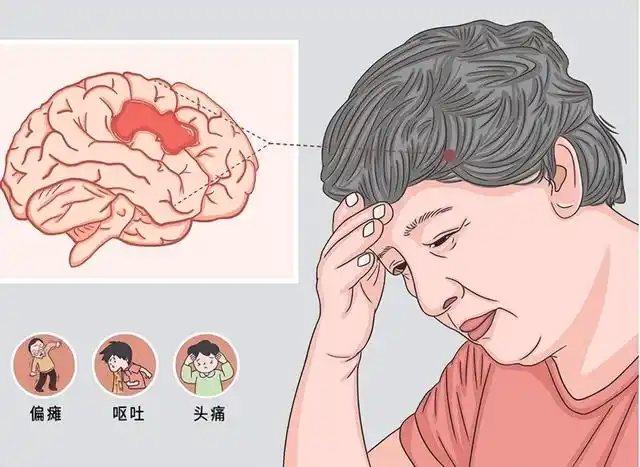 脑出血后遗症请收好这4个康复训练方法,帮助恢复
