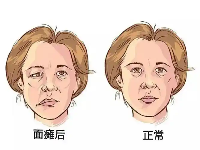 洗澡后空调、风扇直吹为何会引发面瘫？不及时治疗后果有多严重？