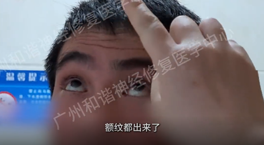 【查房日记】阴雨闷热季面瘫高发！43 岁男子贪凉中招，从 “僵尸脸” 到额纹重现，神经修复立竿见影|广州面瘫后该怎么治疗？
