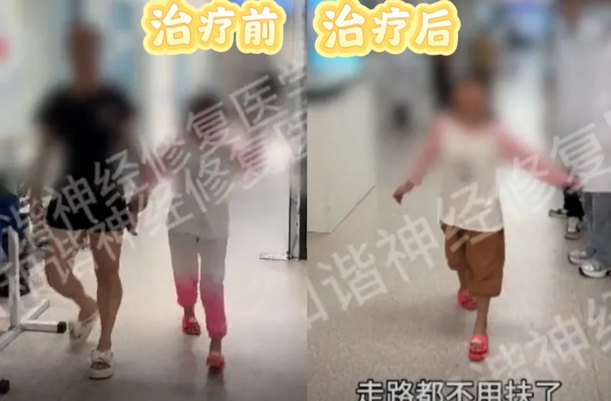 【纪实案例】脑炎患儿的康复希望!病毒性脑炎后遗症致肢体障碍,神经修复让她稳稳迈出每一步|广州病毒性脑炎后遗症能治好吗