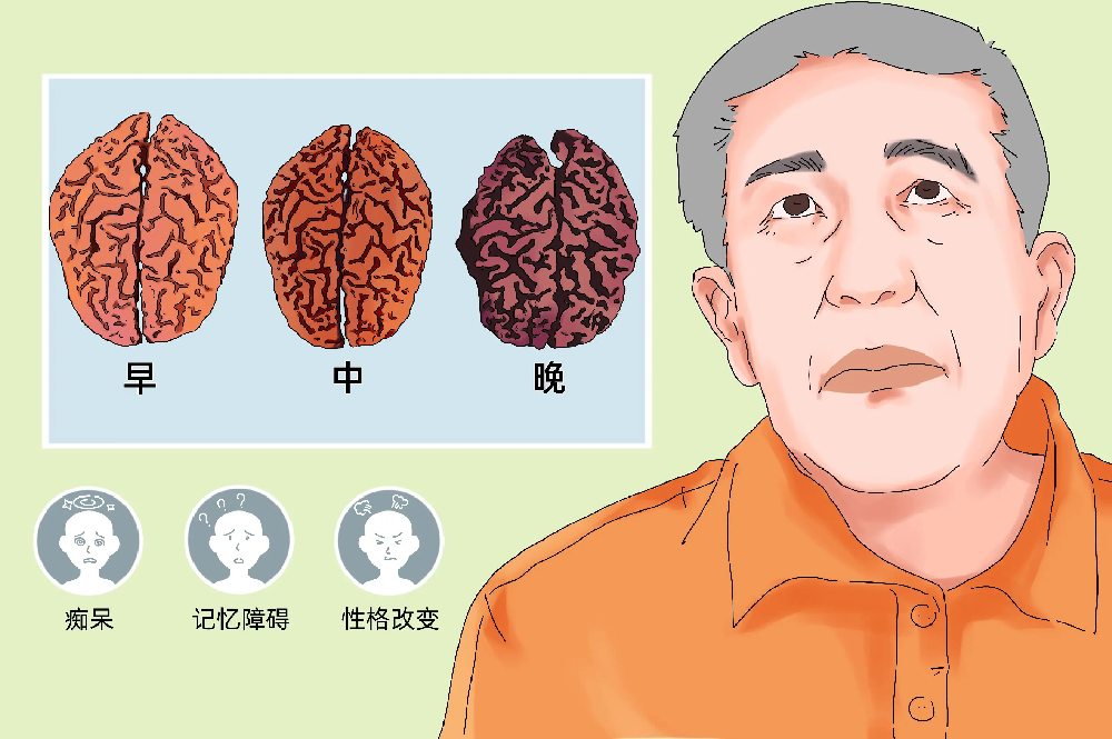 从轻度到重度:全面认识脑萎缩的发展历程