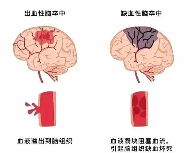 秋冬易发脑卒中,这些知识点需谨记!
