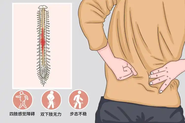 脊髓损伤患者居家康复指南:简单易行的安全训练法