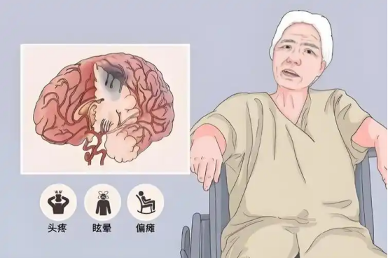 脑梗前兆有哪些?出现这3个信号要警惕