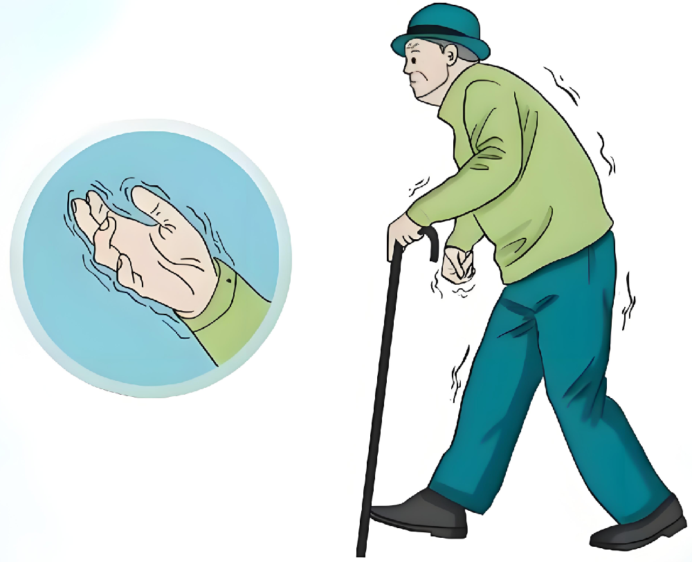 帕金森病:不是“老了抖”,而是大脑里的“指挥家”倒下了