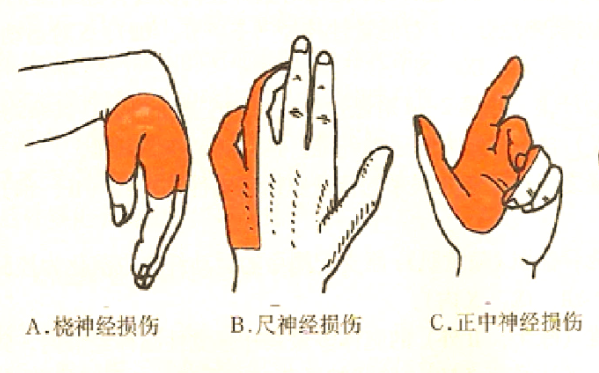 手麻、无力别硬扛!出现这3种手掌畸形,说明神经已经受损,别再拖