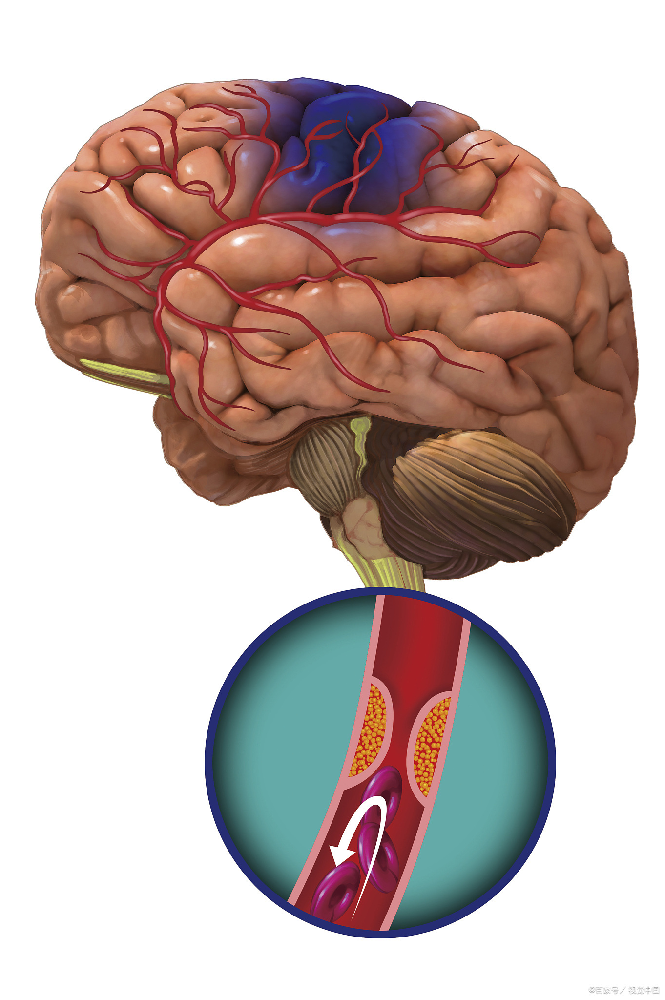 你吃对了吗?看似清淡的饮食,实则悄悄损伤血管!脑梗、脑出血后遗症人群千万别踩坑