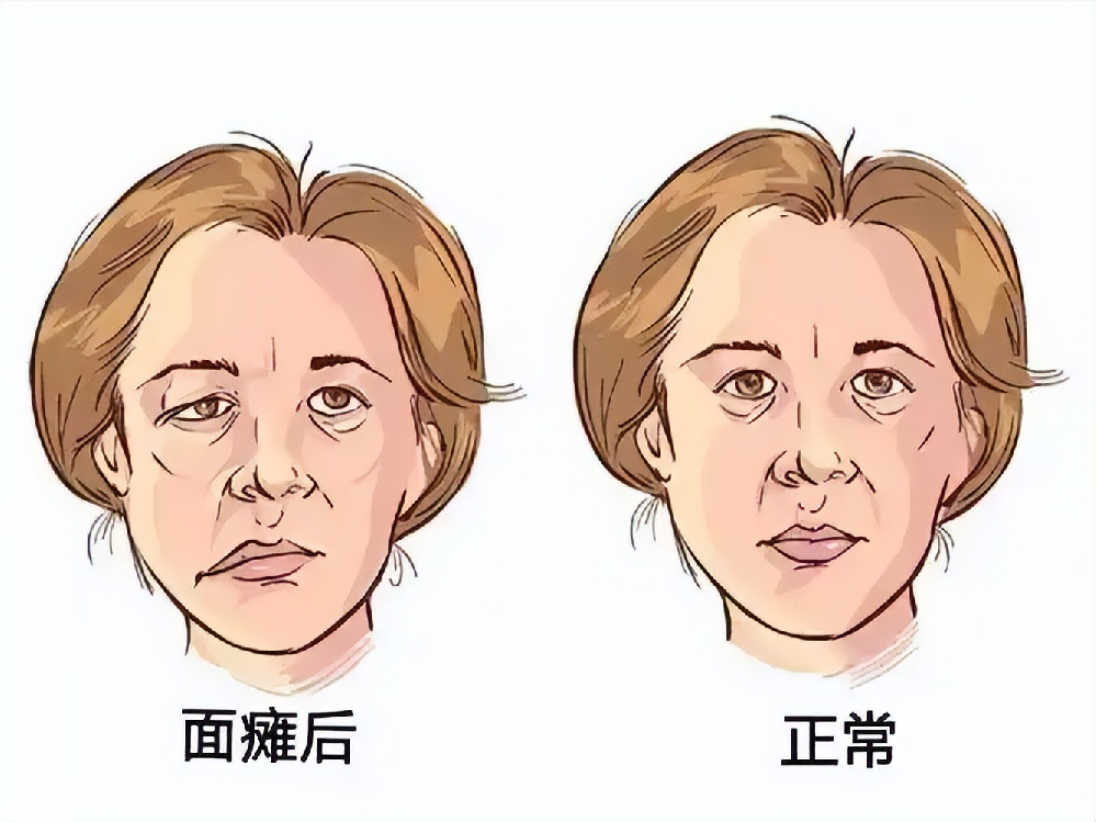 面瘫恢复,别踩这3个“致命误区”