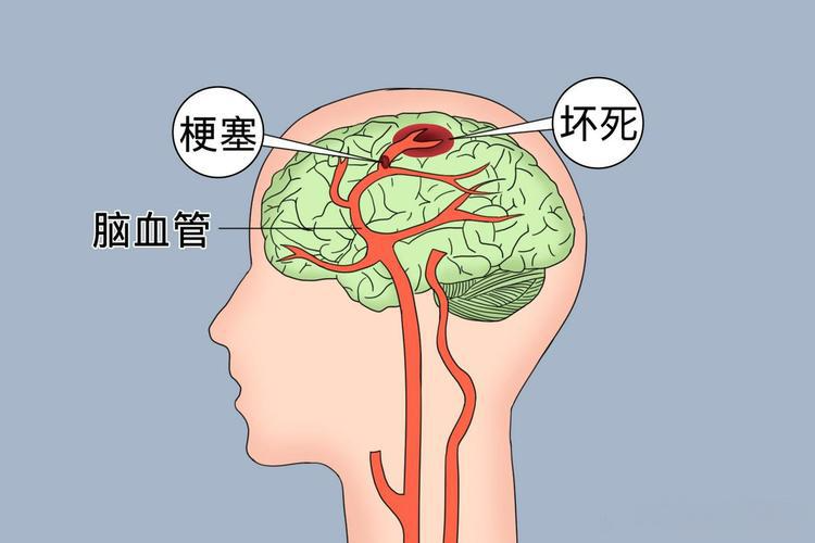 脑梗从何而来?做好5件关键事,科学远离脑梗