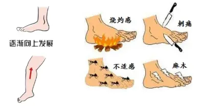 糖尿病周围神经病变:脚部出现6种异常,千万别忽视