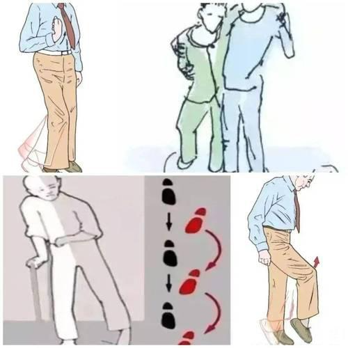 偏瘫走路“五花八门”?看懂你的异常步态,康复少走弯路