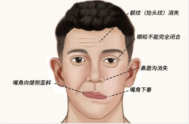 这3个部位莫名疼痛,可能是面瘫来袭!别当成普通小病忽视