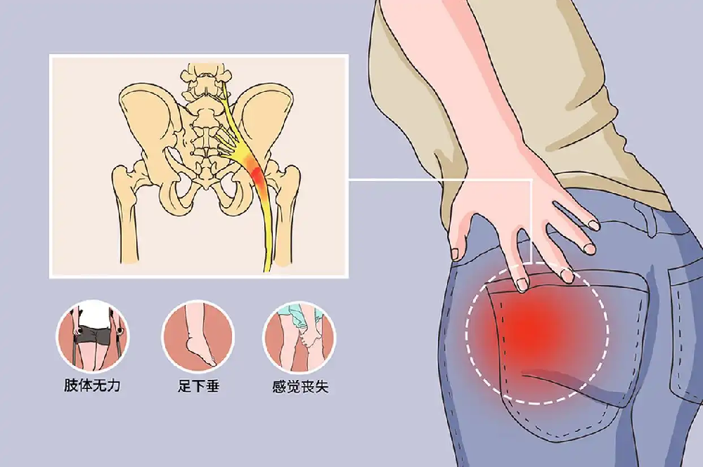 腰痛难恢复?出现这些症状,当心马尾神经损伤找上门