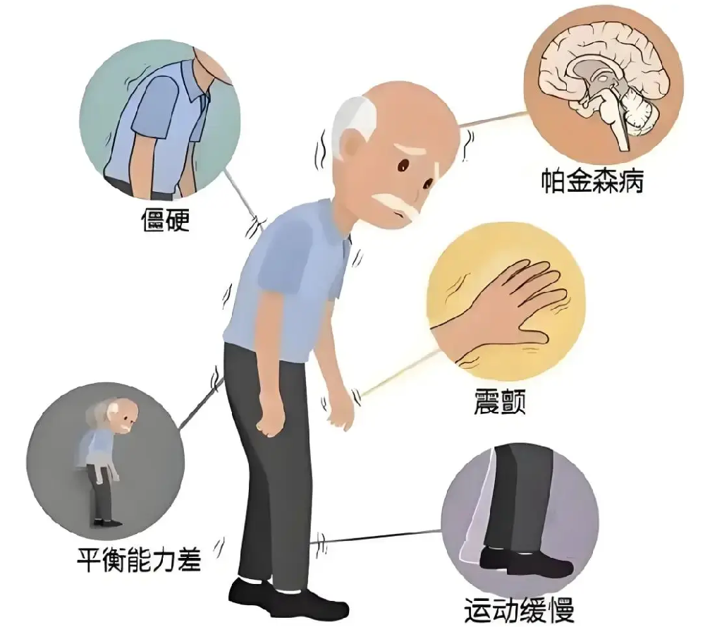 帕金森易被忽略的三大早期信号,别等手抖才就诊
