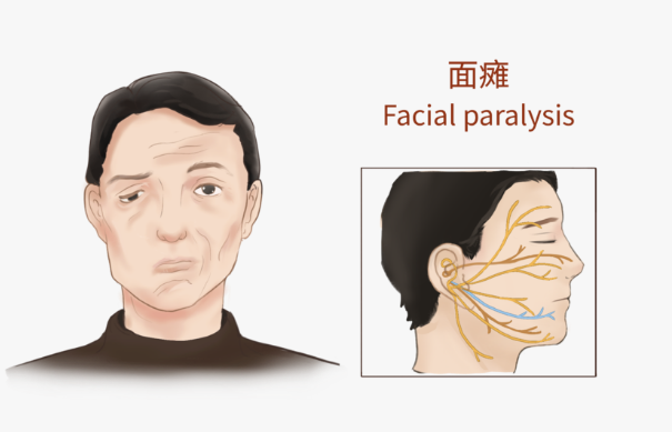 在线答疑：面瘫拖延三个月不见效，是不是进入后遗症期？